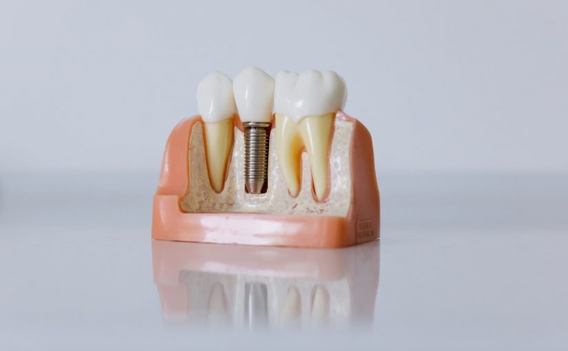 Ką turite žinoti prieš dantų implantavimą